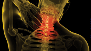 Recovery From Whiplash Injuries Linked To Fat In Muscle