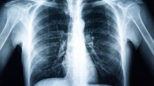 mining lung disease x ray